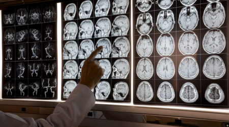 Doctor pointing at MRI of human brain